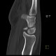 Fracture of scaphoid bone, dislocation of pisiform bone, abruption of lunate: CT - Computed tomography